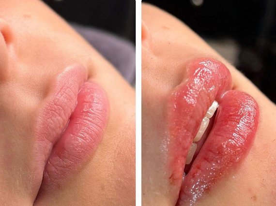 Lippen – Lippenaufpolsterung ohne Nadel in Hamburg